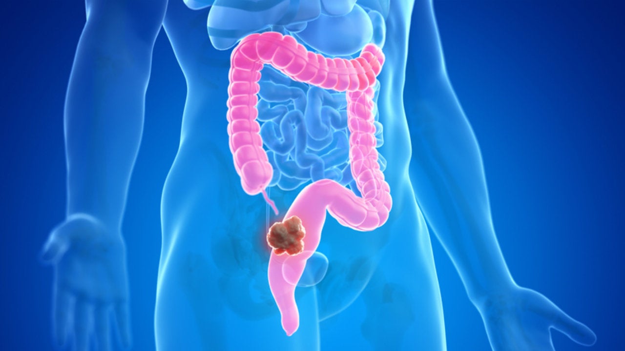 El cáncer de colon es uno de los más extendidos