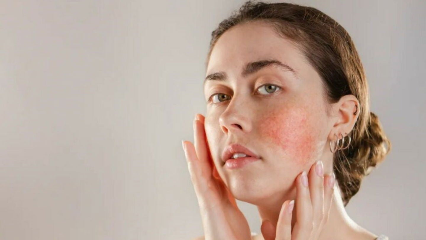 El enrojecimiento es uno de los síntomas clásicos de la piel sensible