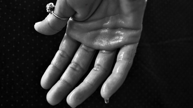 Bótox, una solución cuando la sudoración excesiva no tiene un por qué