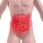 Localización del cáncer de colon