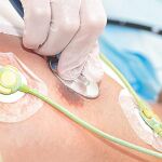 Una terapia usa células cardíacas de donantes para tratar infartos