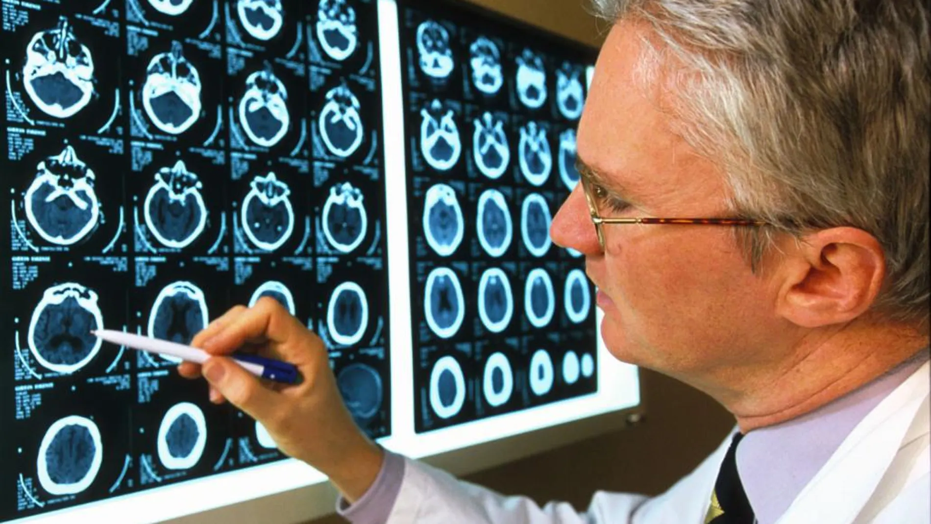 Un fármaco logra retrasar la progresión del Alzheimer un 30 por ciento