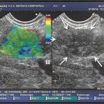 Páncreas «duro», sinónimo de tumor
