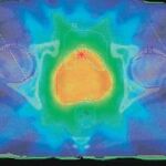 Radioterapia de intensidad modulada avance contra el cáncer por el Dr Rodrígo GARCÍA-ALEJO