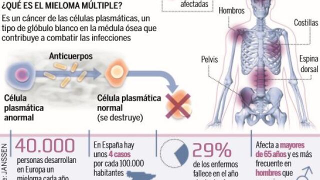 Una estrategia más agresiva logra curar el mieloma múltiple