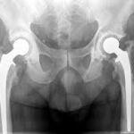 Se desaconseja su toma a personas con fracturas previas