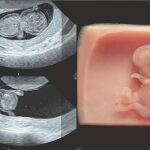 Impresión 3D en el hospital para tratar problemas óseos
