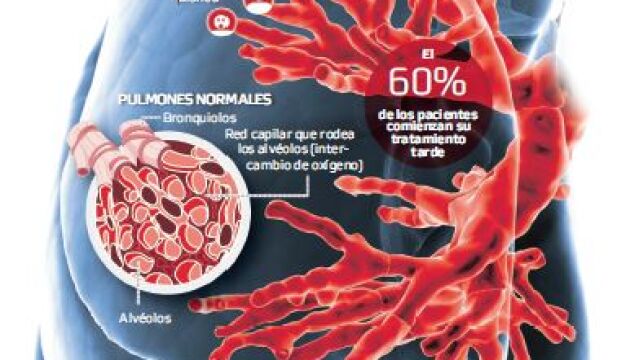 Sólo el diagnóstico precoz frena la fibrosis pulmonar idiopática