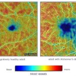 A la derecha, la retina de una persona con la enfermedad de Alzhéimer. Las áreas en azul y verde muestran donde los vasos sanguíneos son menos densos