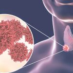 El cáncer anaplásico de tiroides ofrece una tasa de supervivencia a cinco años de sólo el 5%.