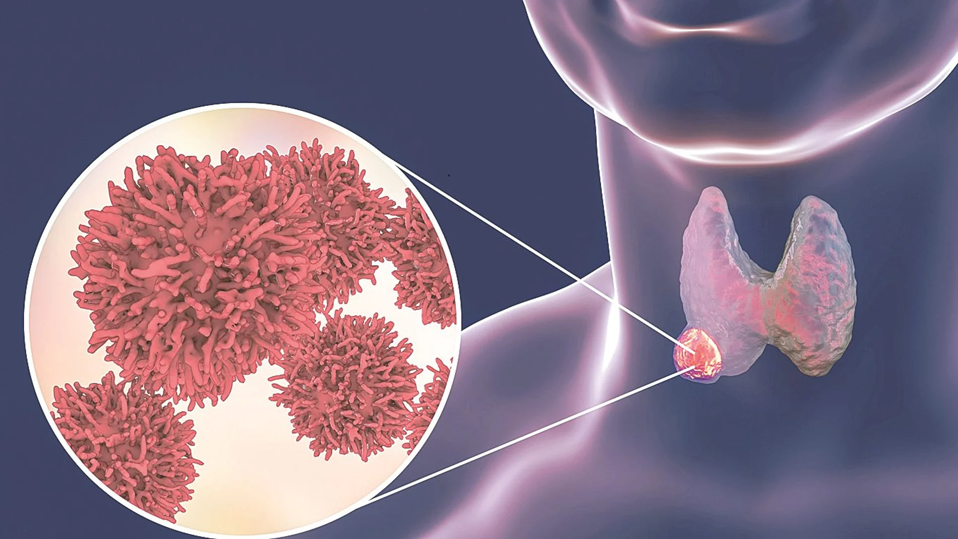 El cáncer de tiroides es la neoplasia endocrina más frecuente