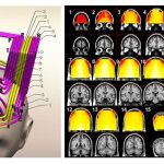 La estimulación magnética profunda puede curar el 71% de las depresiones graves