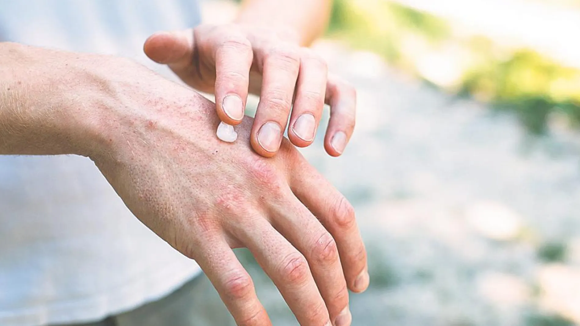 Tras el lavado de agua y jabón se recomienda el uso de crema hidratante para prevenir la aparición de dermatitis