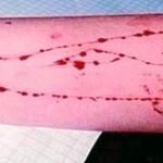 Imagen del brazo de un joven con cortes en forma de ballena azul