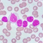 Genoma de la leucemia / Foto: Dreamstime