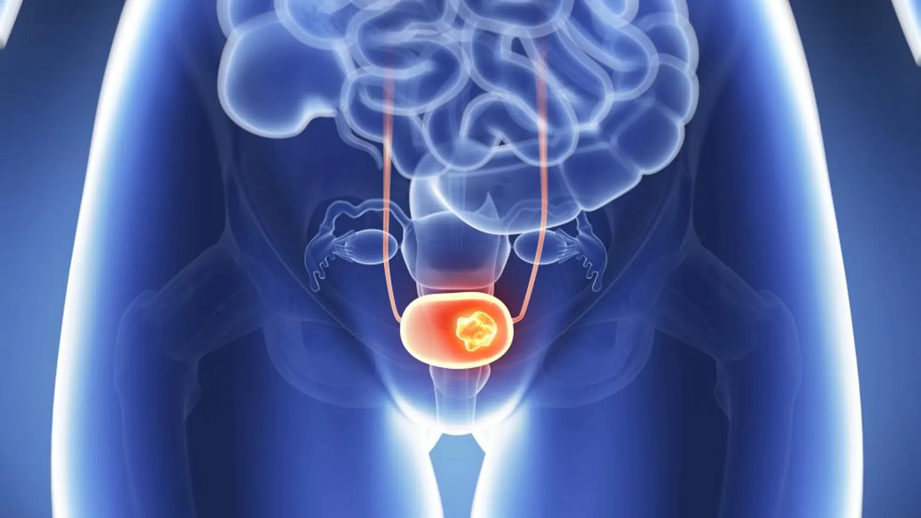 Cáncer de vejiga