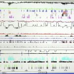 La apnea del sueño está detrás de patologías cardio y cerebrovasculares