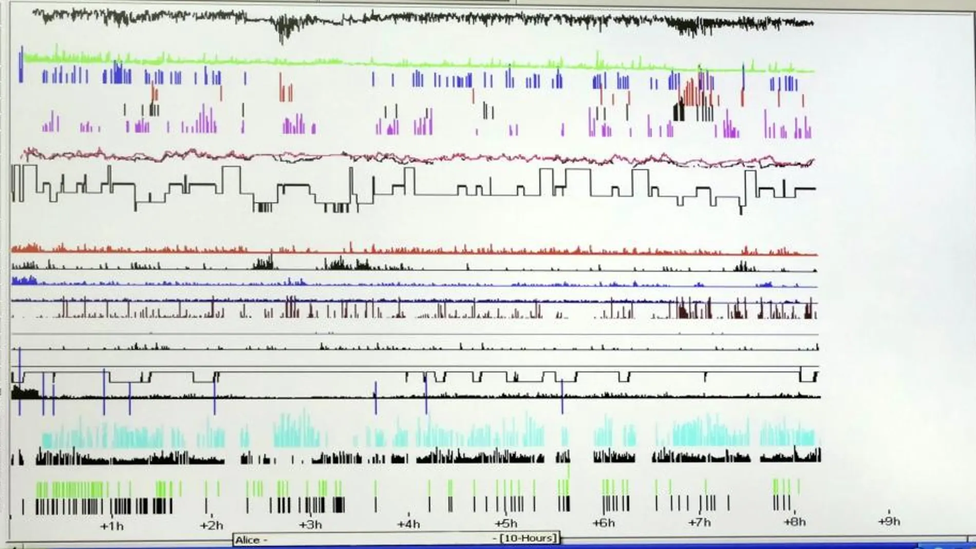 La apnea del sueño está detrás de patologías cardio y cerebrovasculares