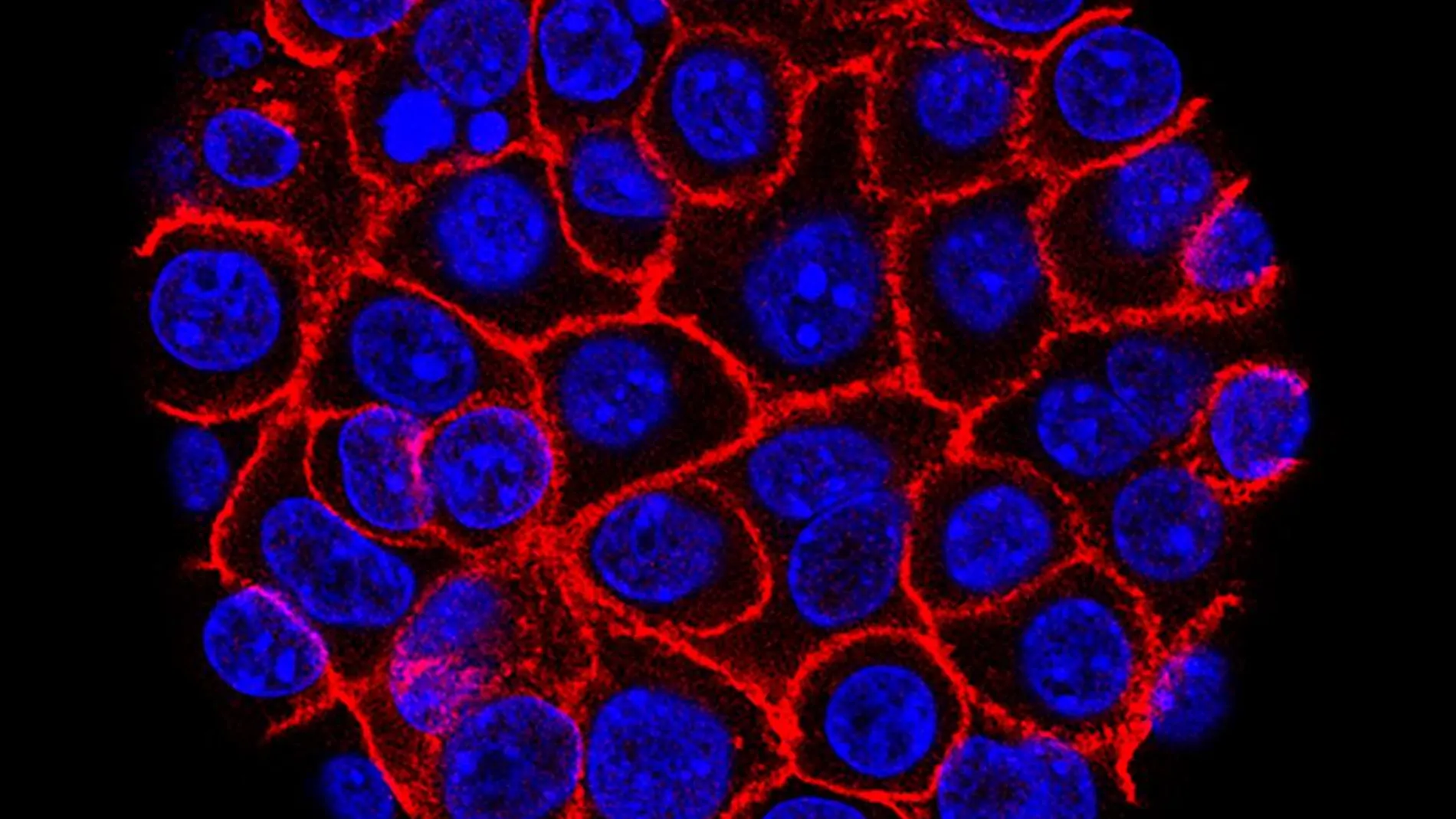 El cáncer de páncreas visto al microscopio