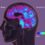 Un fármaco experimental podría curar el Alzheimer