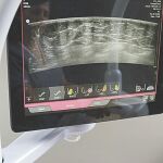 Primer equipo en España que eleva la detección del cáncer de mama