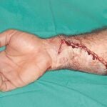 Paciente de 25 años con amputación completa del antebrazo. Momento inmediato después del reimplante