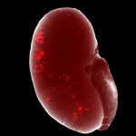 Enfermedad Renal Crónica y Sostenibilidad