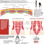 Laparoscopia contra la distensión abdominal