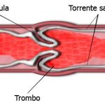 Trombofilia