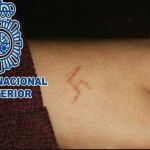 La quemadura le dejó una cicatriz con el símbolo