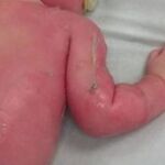 El menor precisó 296 días en curar y tuvo que ser sometido a varias intervenciones quirúrgicas para colocación de injertos cutáneos