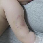 El bebé presenta lesiones compatibles con mordeduras