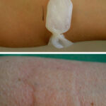 Urticaria
