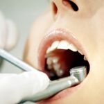Implantes dentales