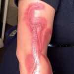 La quemadura en el brazo de la mujer