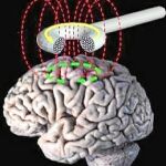 Estimulación magnética transcraneal (TMS)