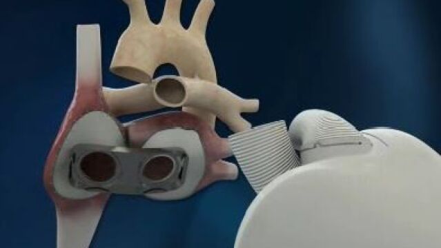 Francia suspende los implantes de un corazón artificial tras la quinta muerte