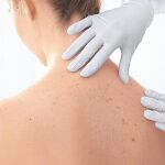 Casi un 80% de la población nunca ha ido al dermatólogo para que le revise sus lunares