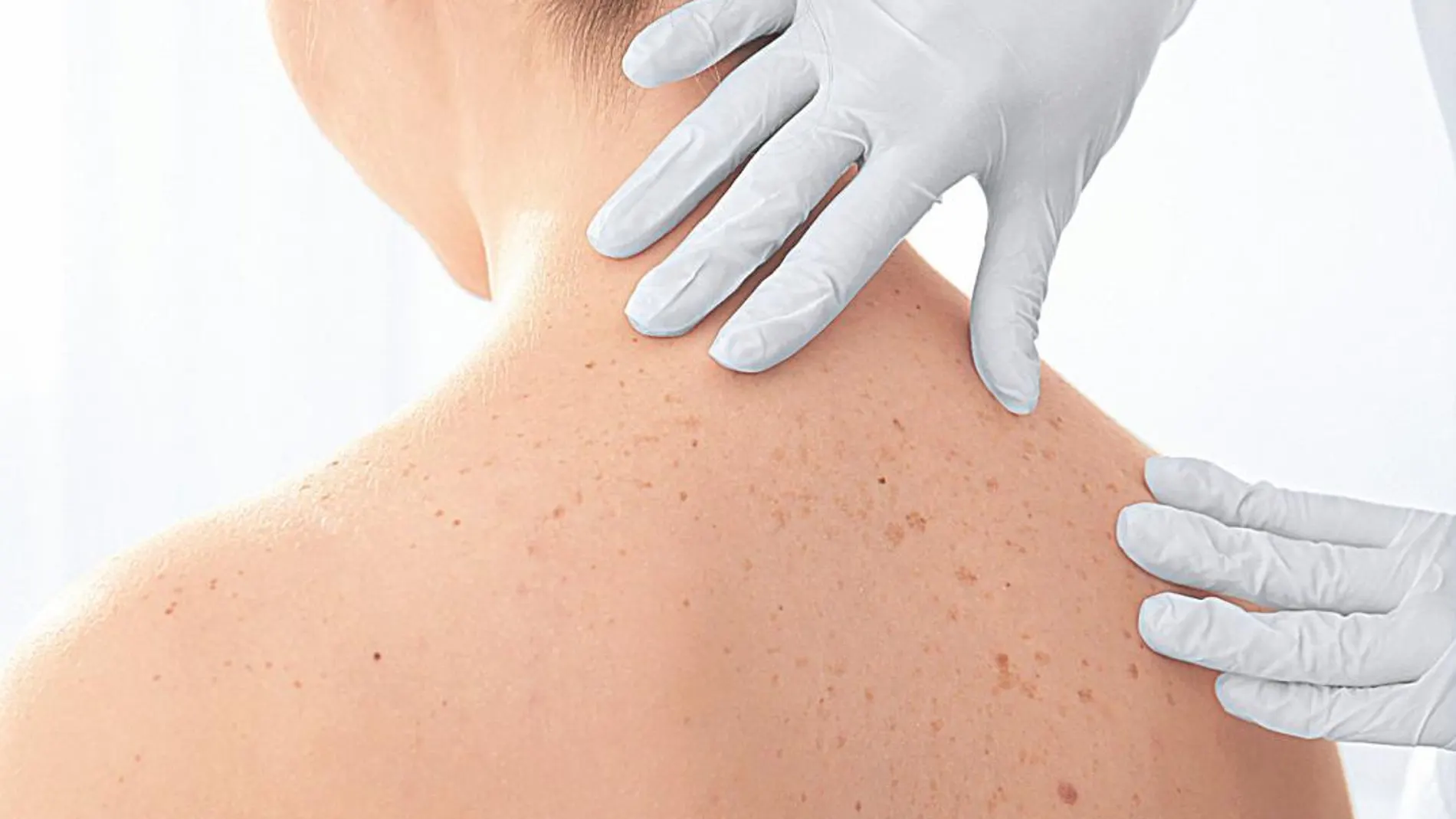 Casi un 80% de la población nunca ha ido al dermatólogo para que le revise sus lunares