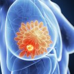 Se trata del tumor más agresivo y representa, aproximadamente, entre el 10% y el 15% de todos los cánceres de mama