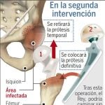 Una intervención más sencilla
