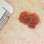 Fotografía de un melanoma en la piel