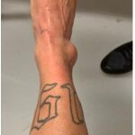 Así quedó el tobillo de Neymar tras su lesión