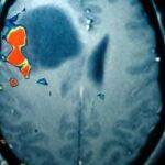 10 preguntas sobre el tumor cerebral