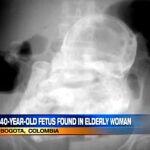 Ecografía del abdomen de la mujer, en la que se distingue perfectamente el contorno del cuerpo del feto