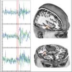 Las tres gráficas de la izquierda muestran la actividad cerebral de tres sujetos antes y después (separación en rojo) de una infusión de psilocibina. A la derecha se aprecia la activación del hipocampo