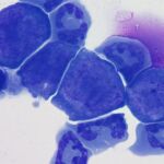 Más del 80% de los casos de cáncer de próstata son curables