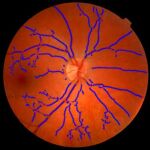 Análisis de la ramificación de venas y arterias en la retina