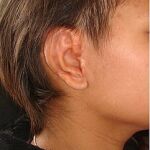 Apariencia de una oreja reconstruida