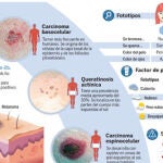 Nuevas armas contra el melanoma